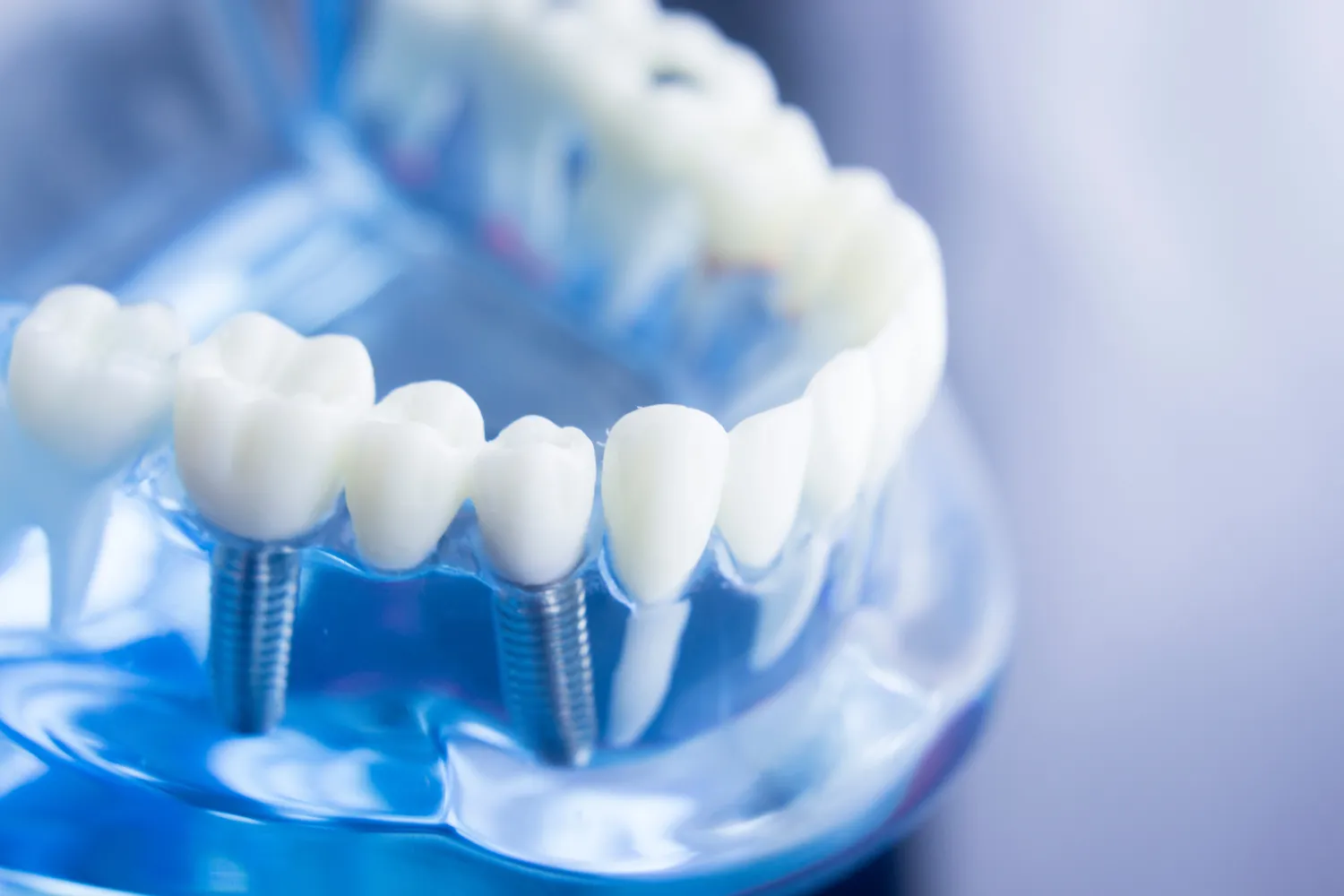 Jak się przygotować do wszczepienia implantów zębów?